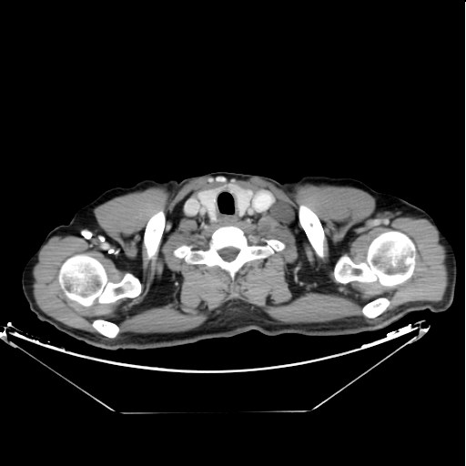 Lymphocele of the thoracic duct



Starting caudally from the level of the renal hila in the abdomen 



Extending cranially towards the mediastinum till its insertion with areas of more focal dilatation mounting to cyst formation.



Left supra-clavicular fossa well-defined oval shaped cyst is seen as well.