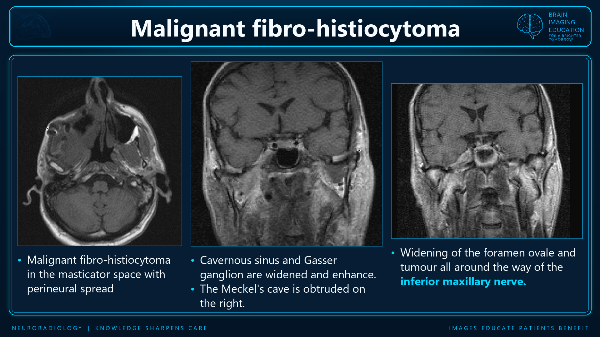 Axial and coronal MRI teaching panels labeled as masticator-space malignancy with perineural spread and right Meckel cave involvement.