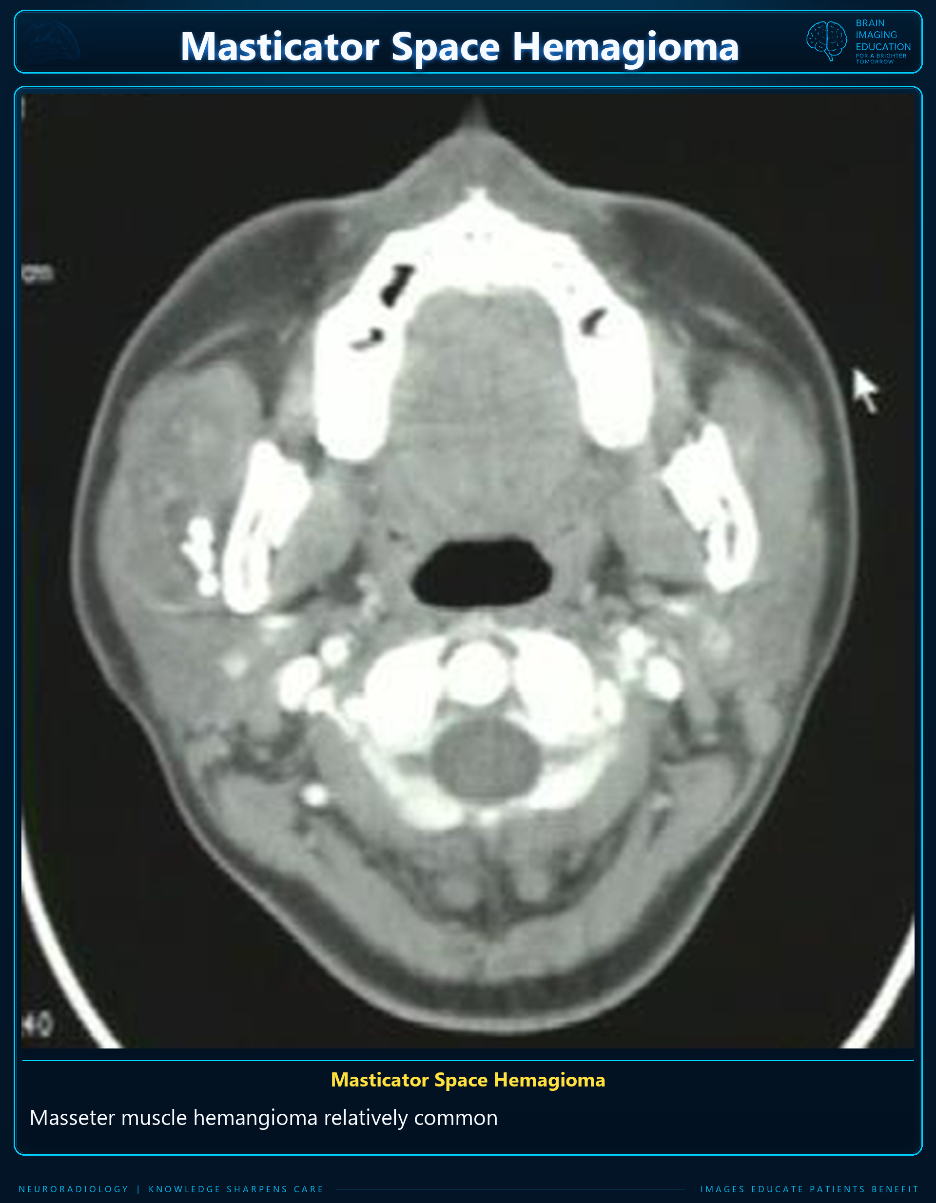 Axial CT teaching image labeled as a masseter muscle hemangioma.