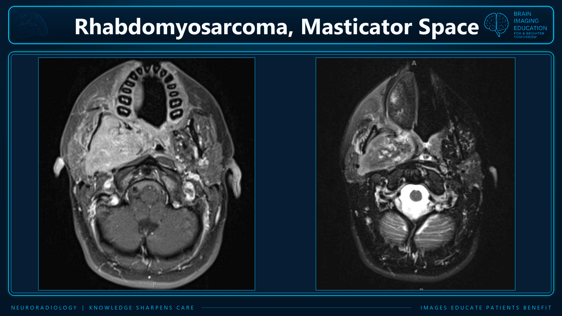 Two axial MRI panels labeled as rhabdomyosarcoma of the masticator space.