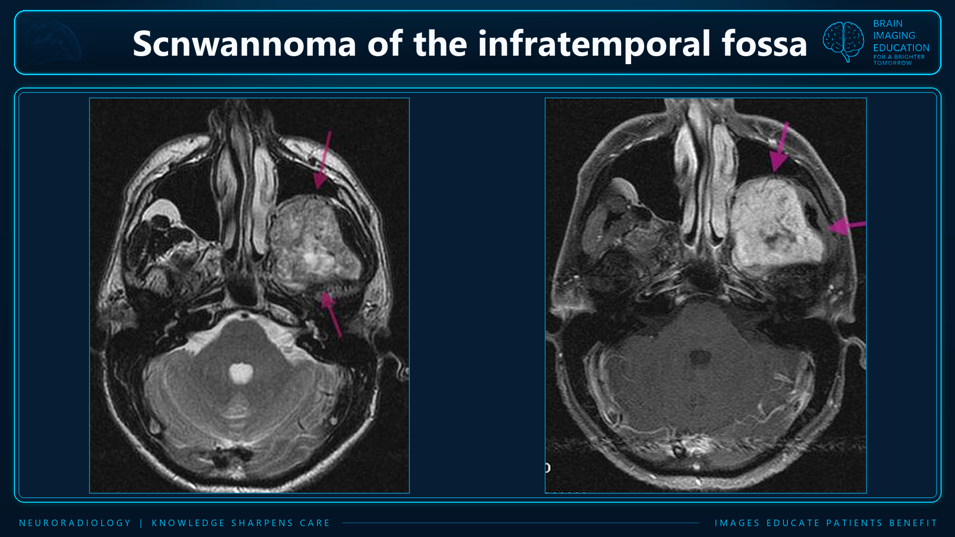 Two axial MRI panels with original magenta arrows marking the mass labeled as an infratemporal fossa schwannoma.