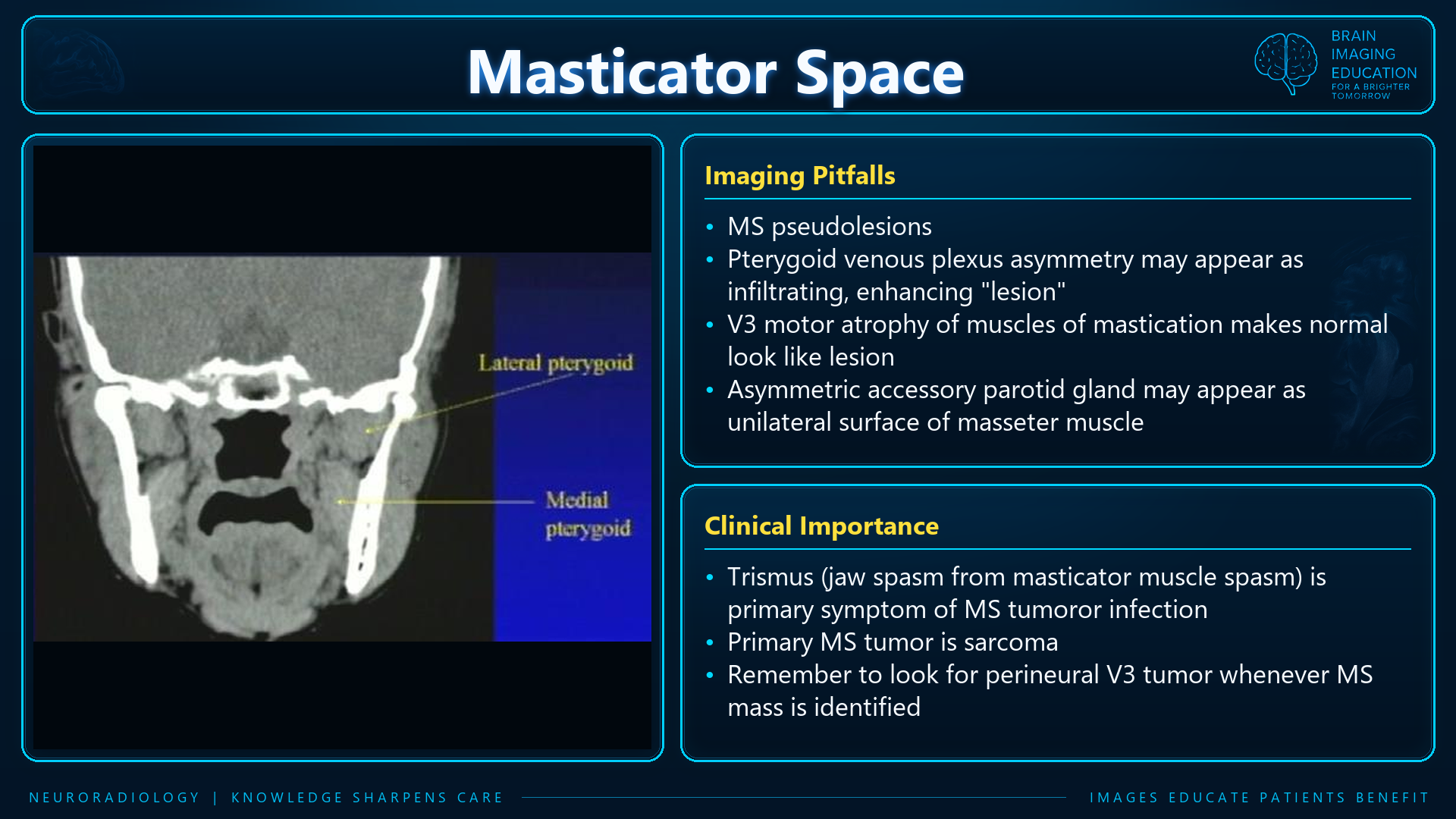 Coronal CT showing the pterygoid muscles alongside teaching notes on imaging pitfalls and clinical importance.