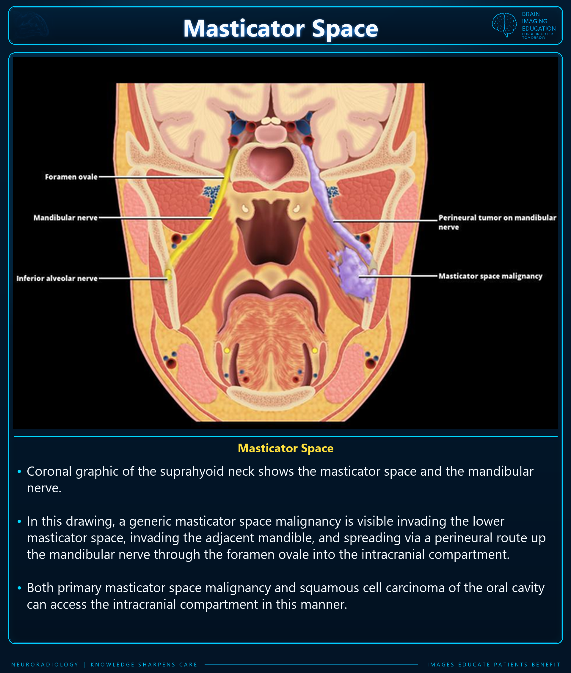 Coronal illustration showing masticator space malignancy spreading along the mandibular nerve through the foramen ovale, with explanatory text.