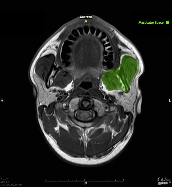 Axial MRI with the left masticator space highlighted in green and original orientation markers preserved.