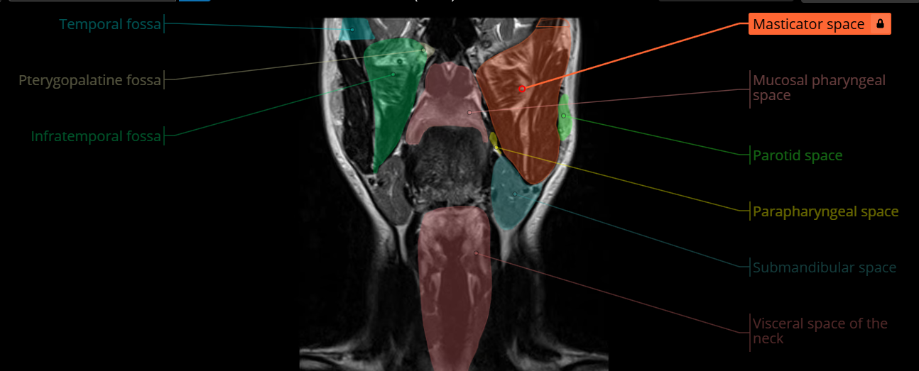Annotated coronal MRI with an orange masticator space overlay and labels for adjacent head and neck spaces.