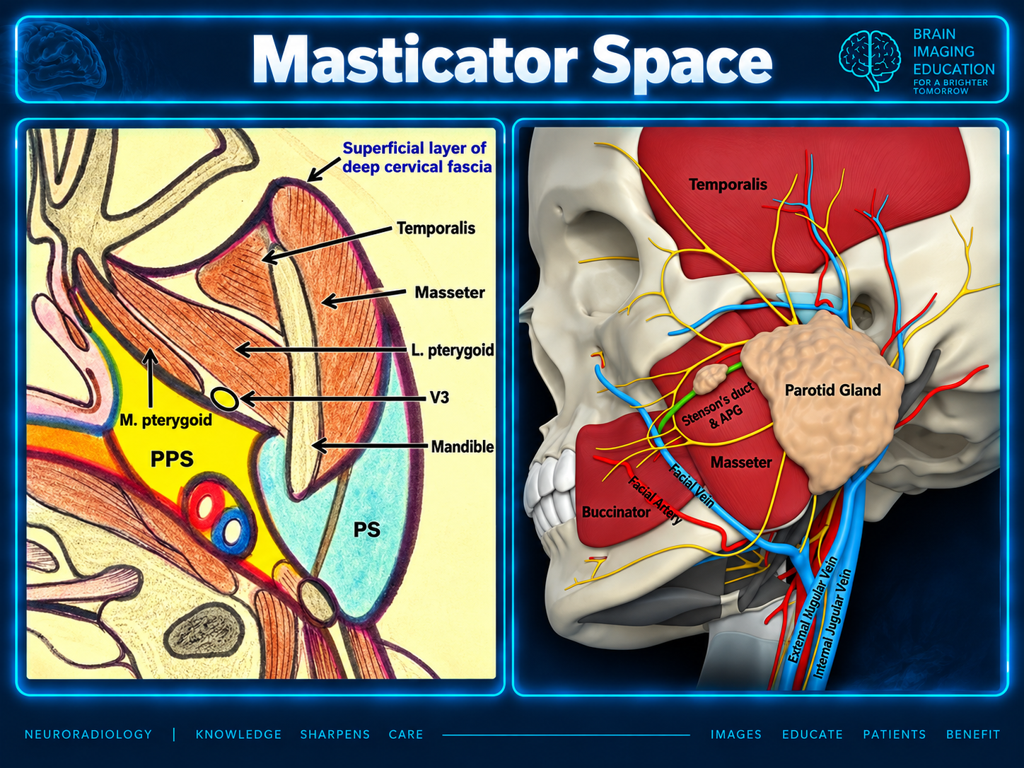 Anatomic teaching graphic labeling fascia, temporalis, masseter, pterygoid muscles, V3 and mandible, beside a lateral skull illustration.