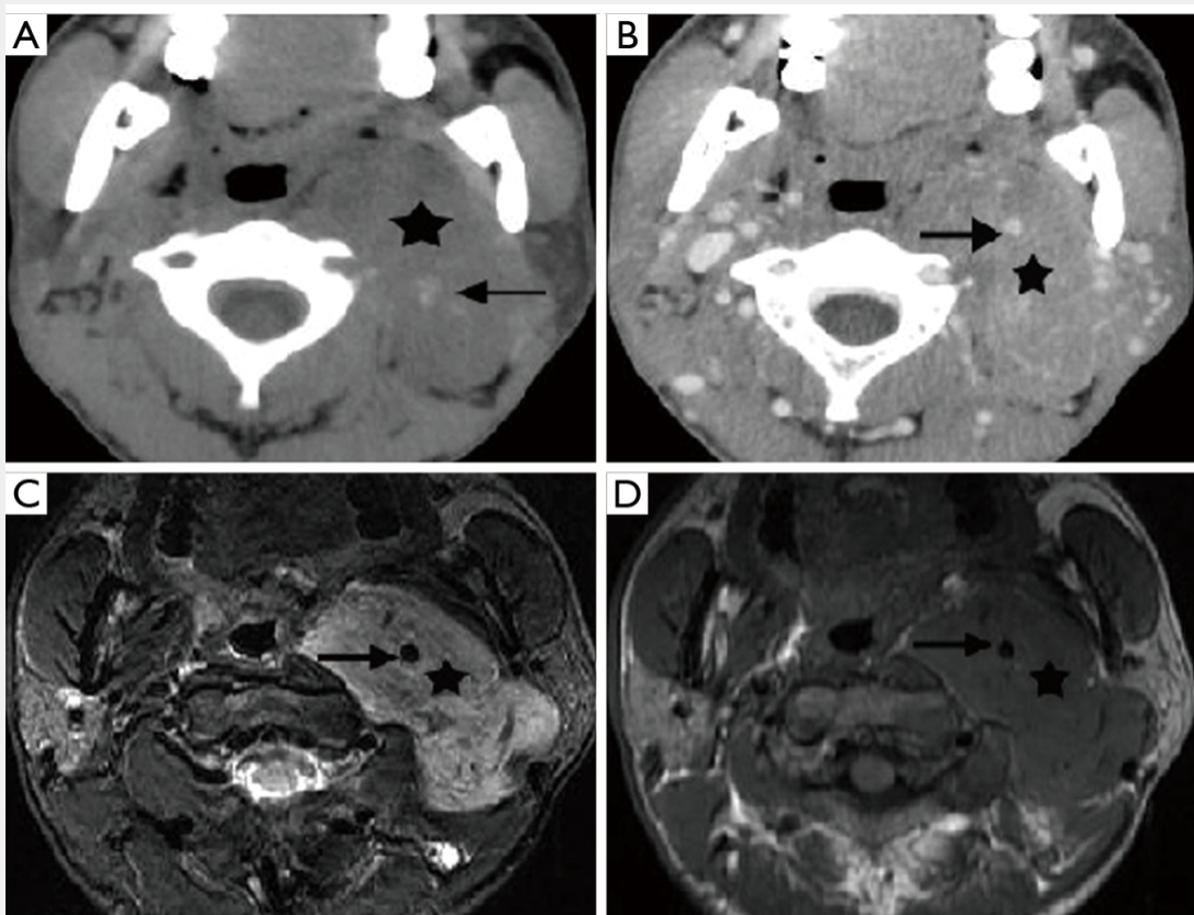 Meningioma of left carotid space without intracranial continuity in a 23-year-old male. 



(A) Axial unenhanced CT scan shows an otherwise homogeneous mass (star) with calcification (arrow). 



(B) Axial contrast-enhanced CT scan shows the mass with medium-degree enhancement (star).  The ICA (arrow) is encased by the mass. (C,D) Axial T2-weighted 



(C) and axial T1-weighted 



(D) images show the mass (stars) with hyperintensity in T2WI and slightly hypointensity in T1WI, which encases the ICA (arrows). CT, computed tomography; ICA, internal carotid artery; T1WI, T1-weighted imaging; T2WI, T2-weighted imaging.