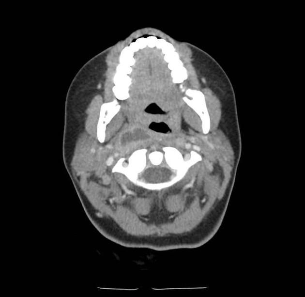 Axial neck CT supplied as an abscess example.