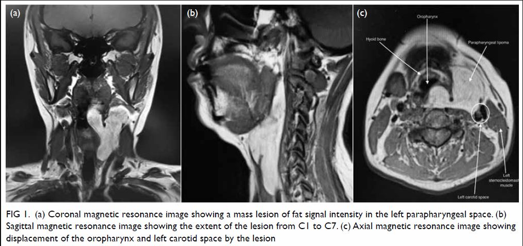 Coronal, sagittal and axial MRI of a labeled left parapharyngeal lipoma with original figure caption.