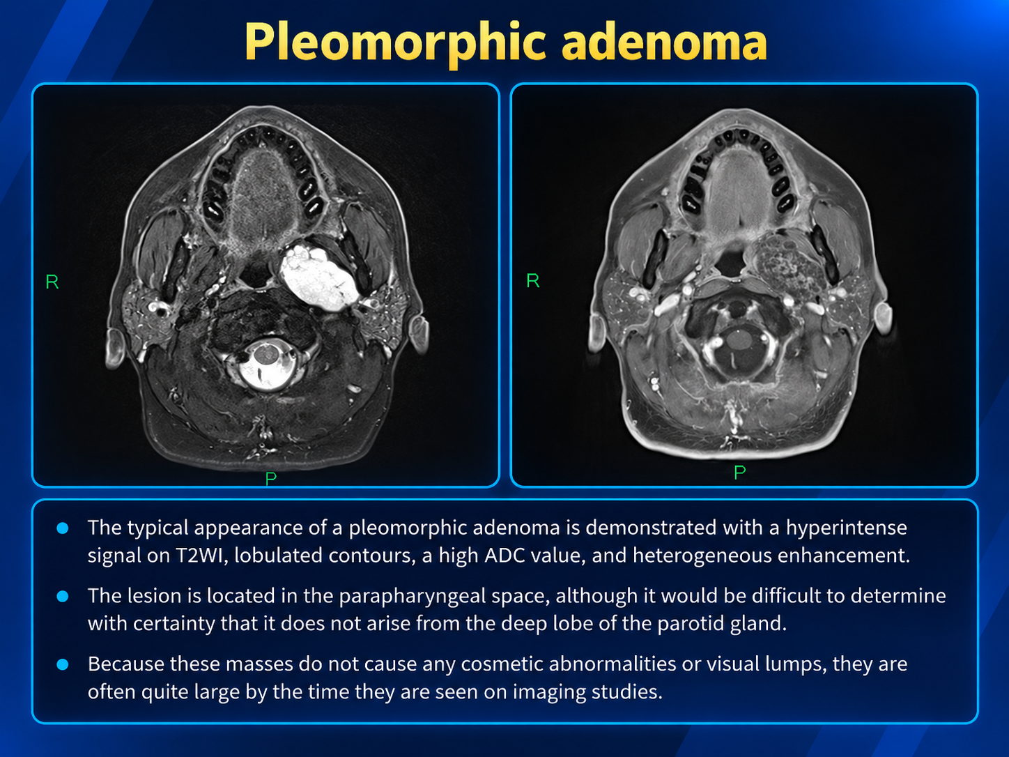 Axial MRI panels showing the labeled pleomorphic adenoma in the left parapharyngeal region.