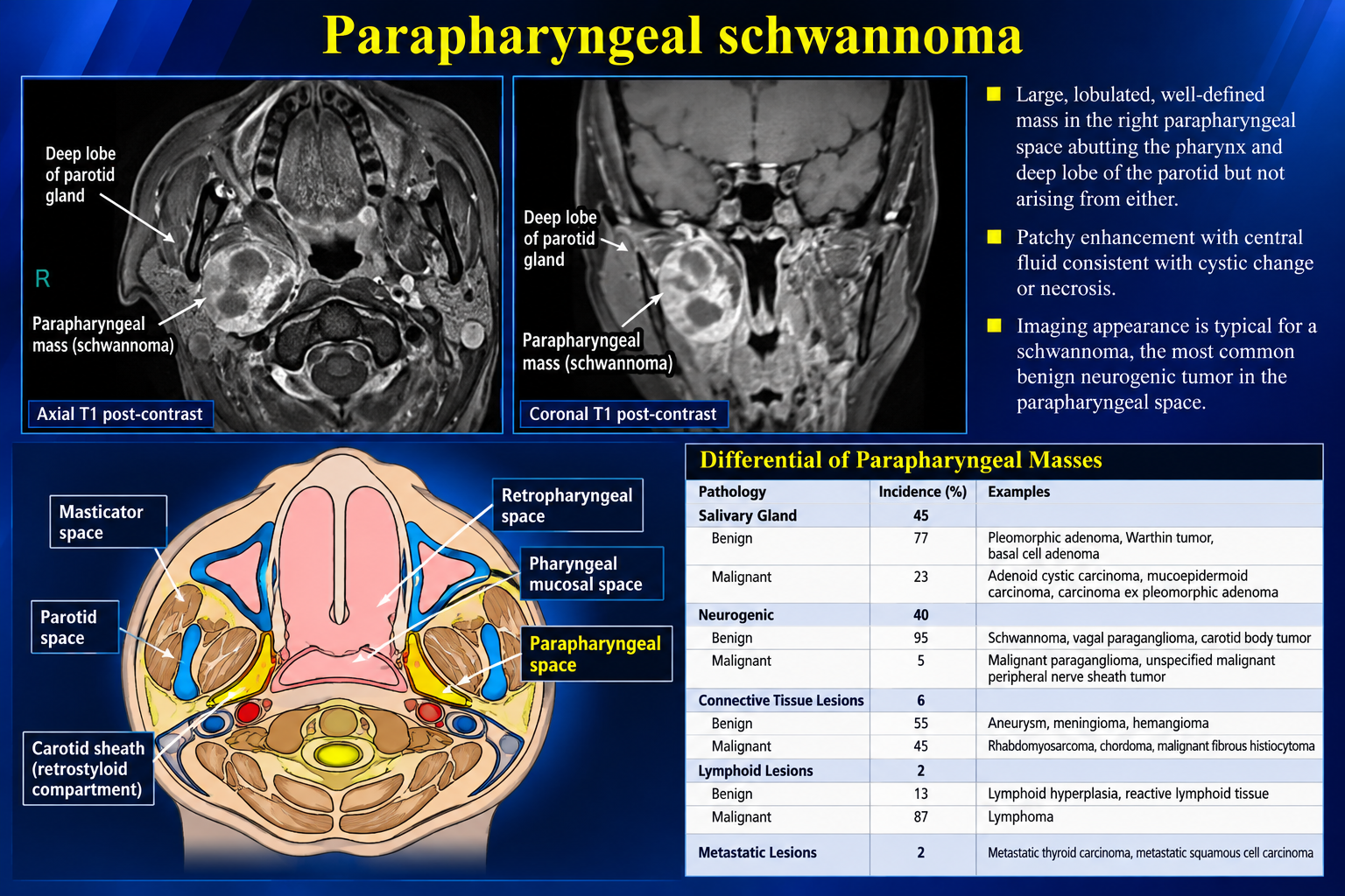 Axial and coronal postcontrast MRI of a labeled right parapharyngeal schwannoma with anatomy and differential table.
