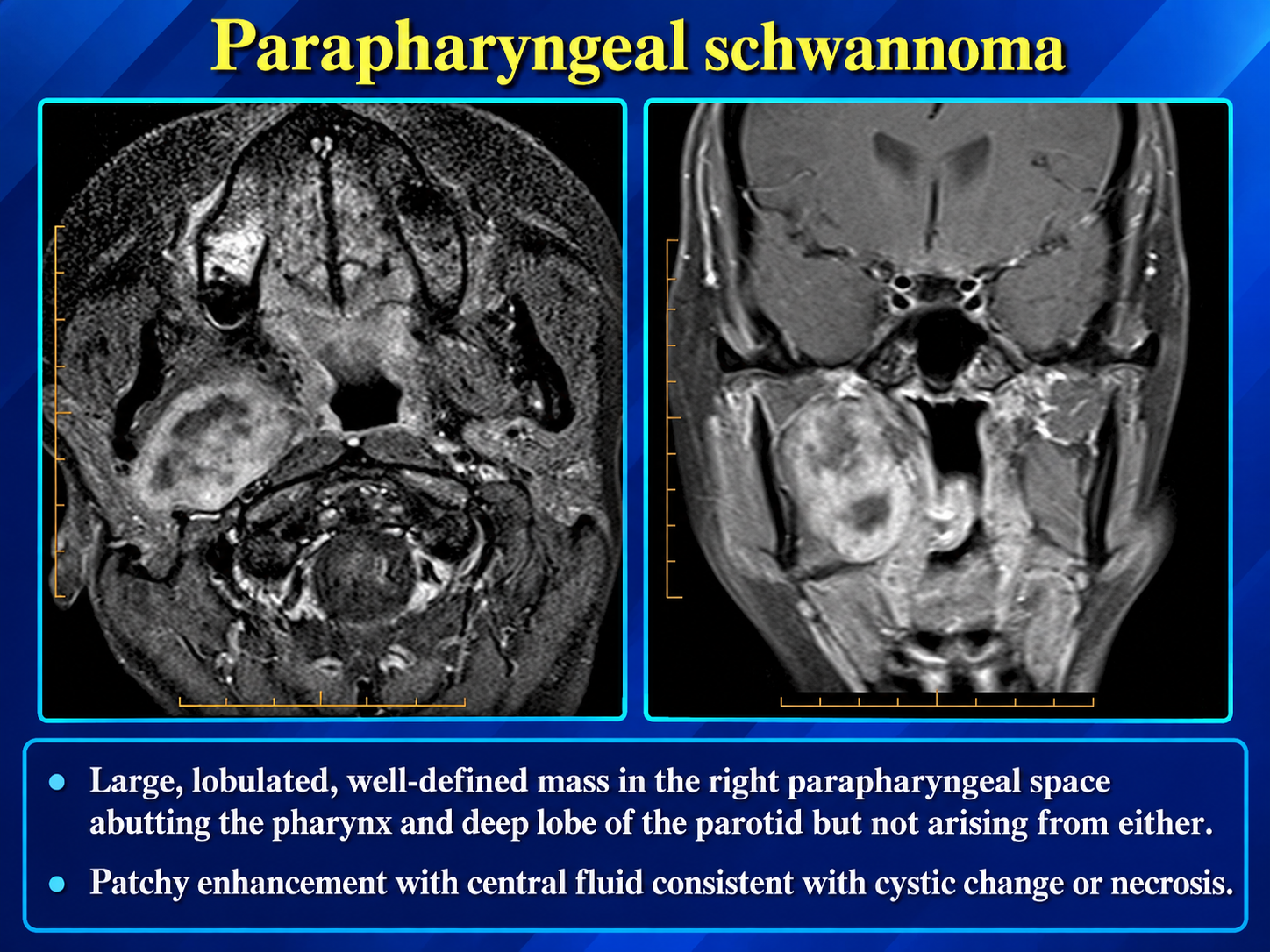 Axial and coronal MRI showing the labeled right parapharyngeal schwannoma with heterogeneous enhancement.