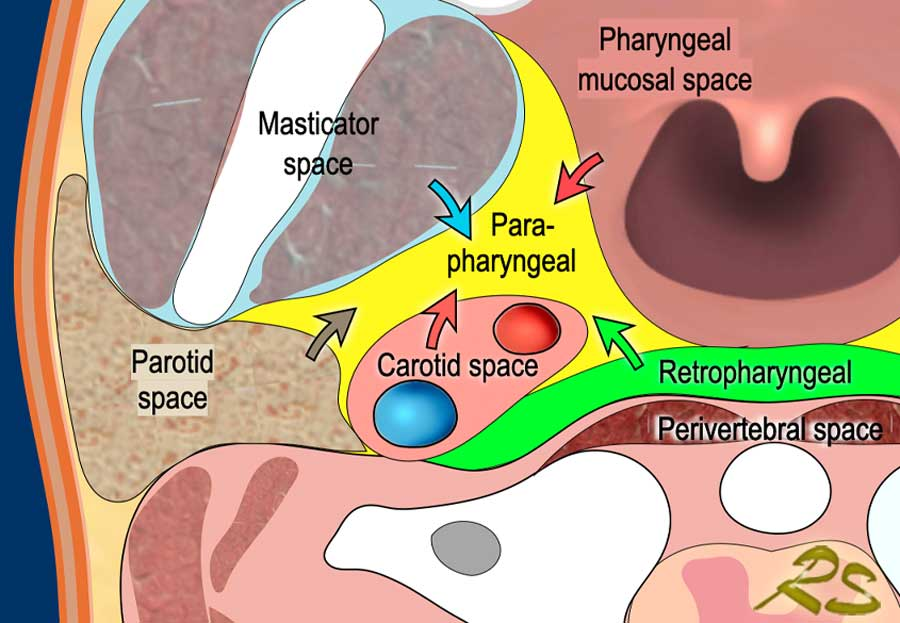 Axial anatomy diagram labeling PPS and adjacent deep neck spaces with displacement arrows.