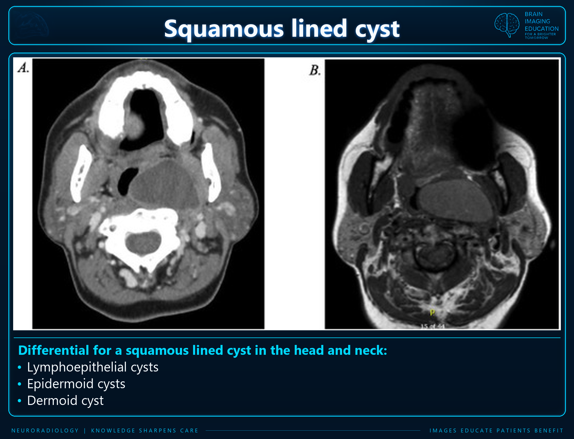 Axial CT and MRI panels of the labeled squamous lined cyst.