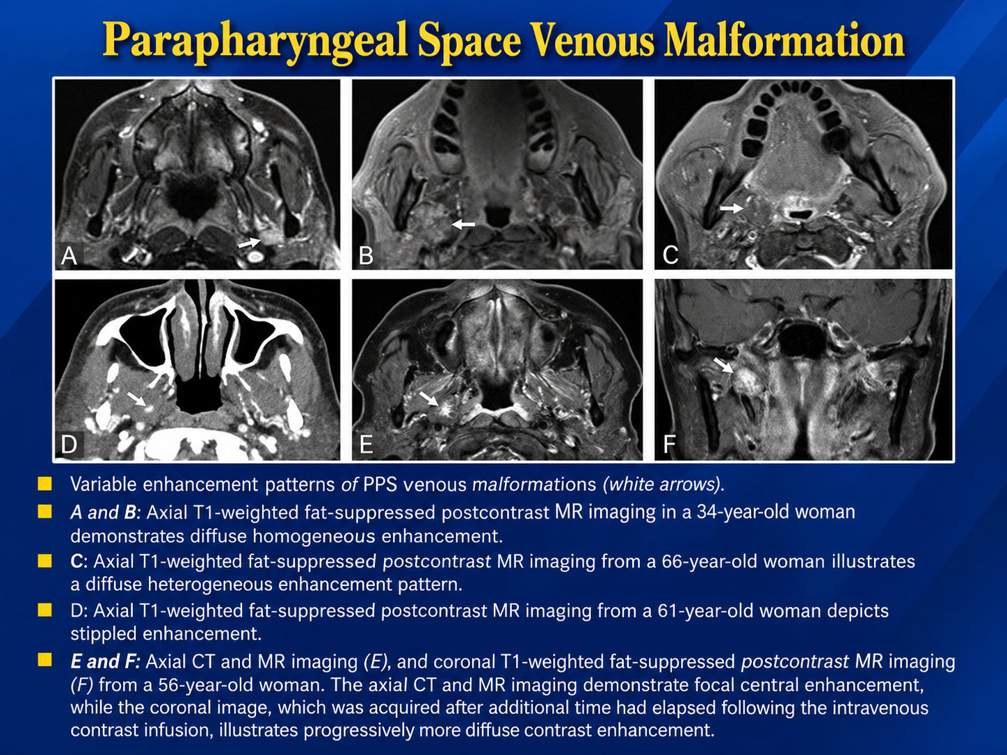 Six CT and MRI teaching panels with arrows marking labeled PPS venous malformations and original enhancement descriptions.