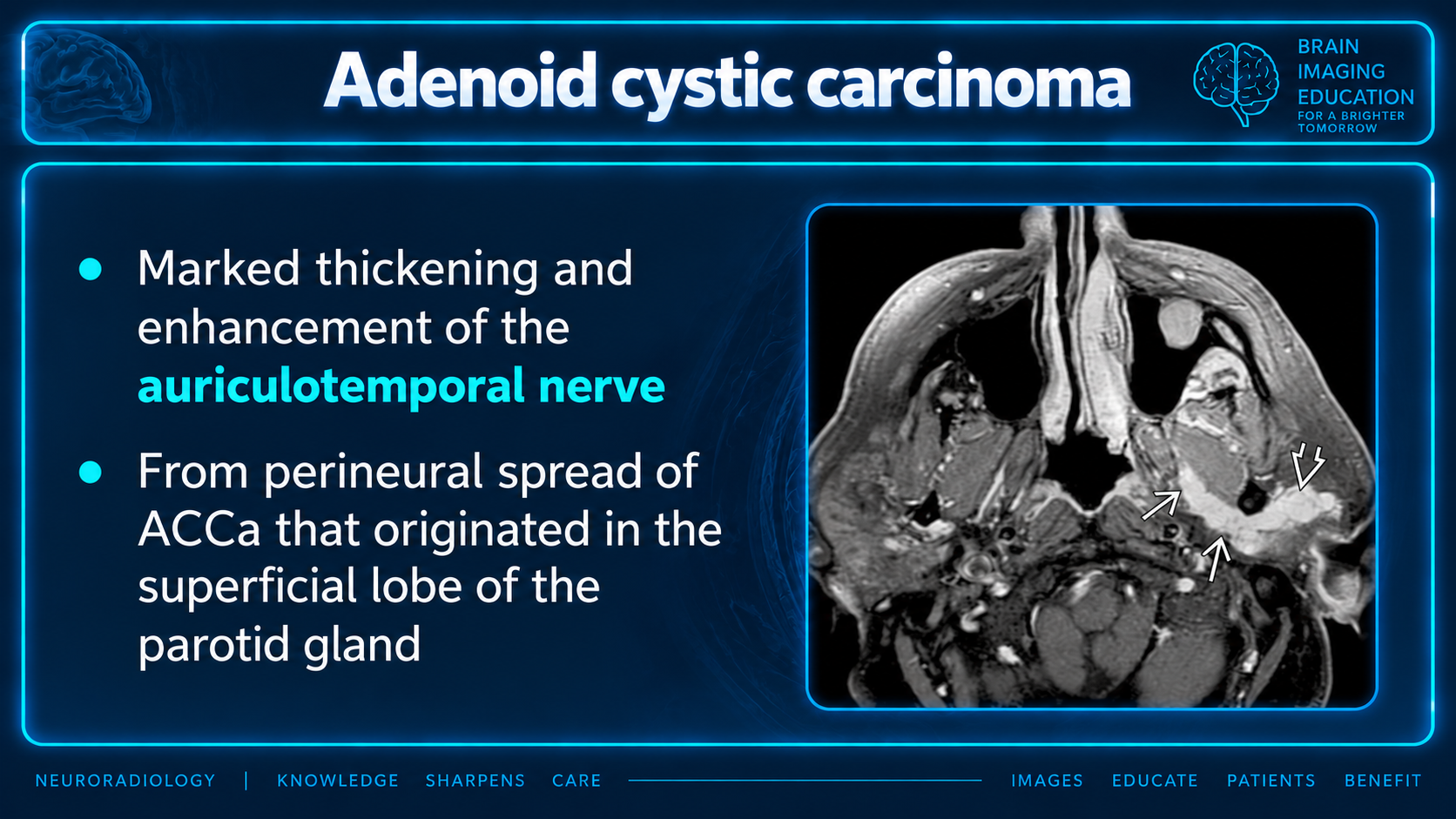 Axial contrast-enhanced MRI with white arrows indicating thickening and enhancement along the auriculotemporal nerve in the parotid region.