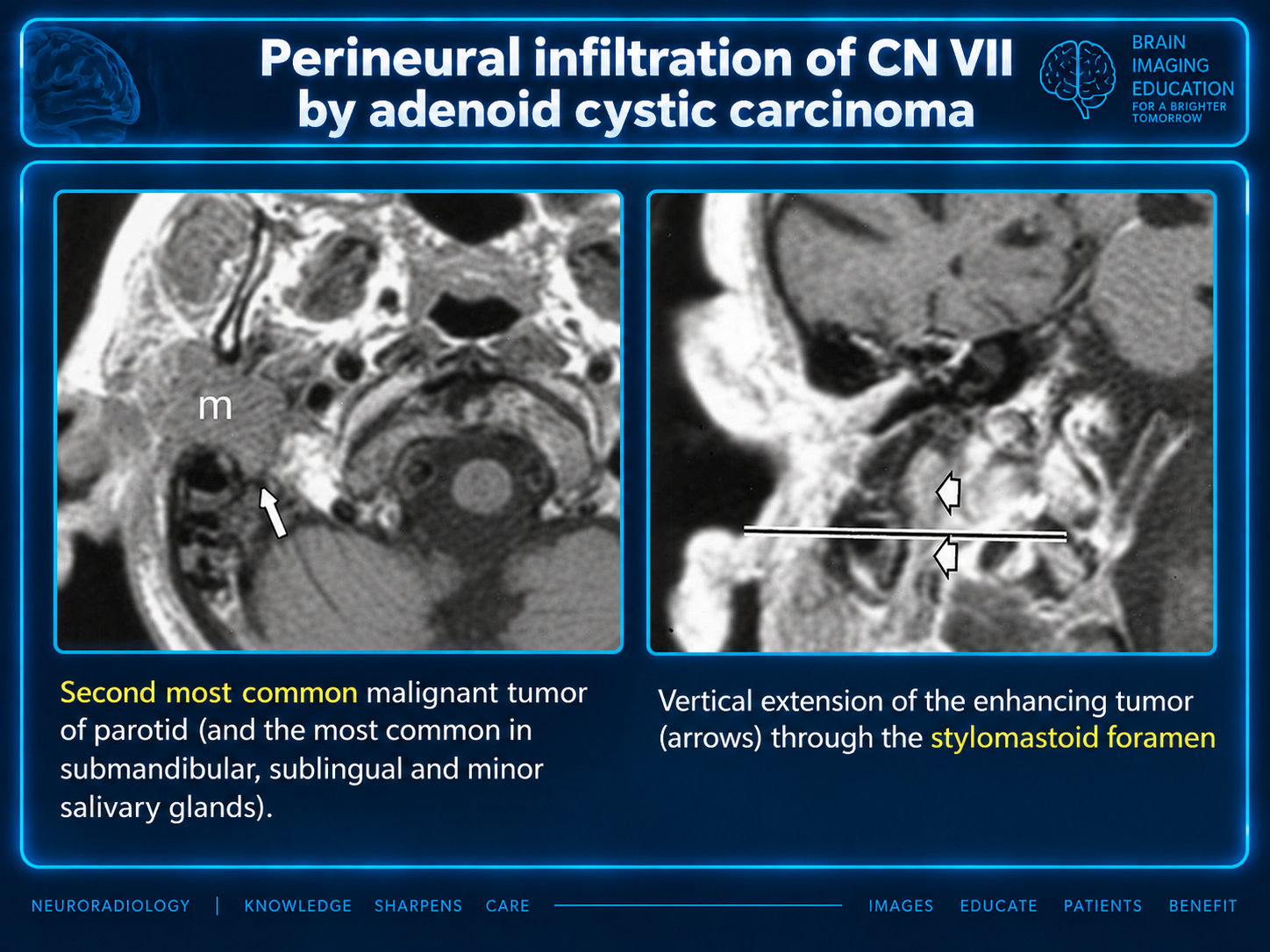 Axial and coronal MRI with arrows showing enhancing tumor extending through the stylomastoid foramen along CN VII.
