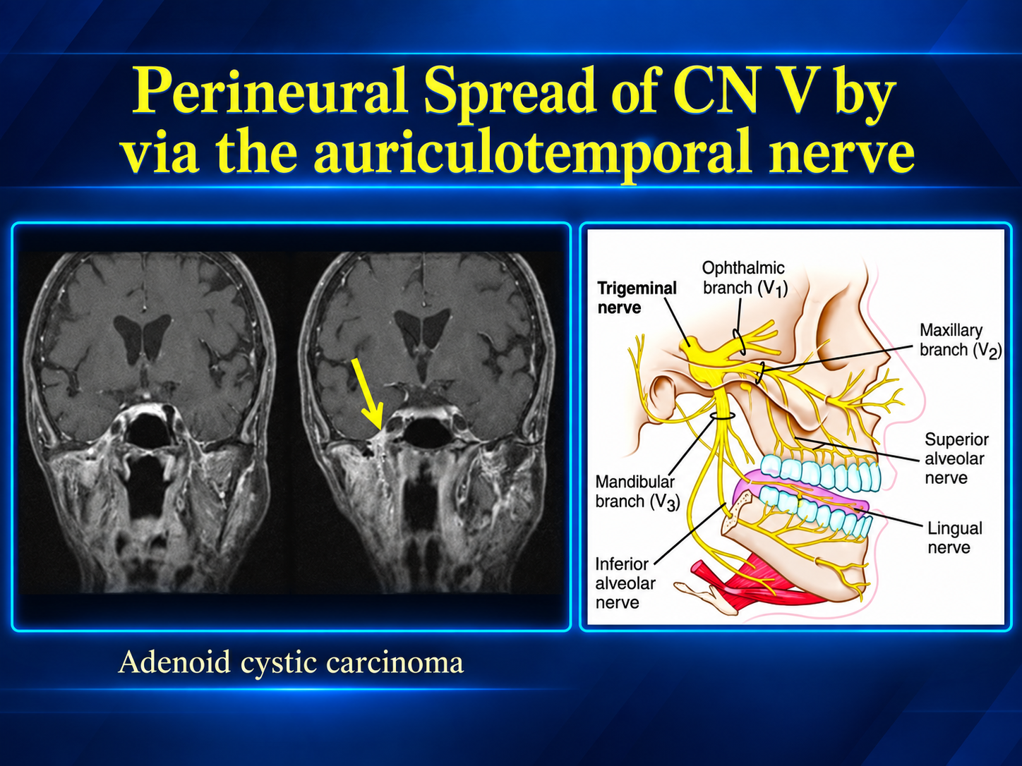 Two coronal contrast-enhanced MRI images with a yellow arrow marking the illustrated CN V spread, beside a labeled trigeminal nerve diagram.