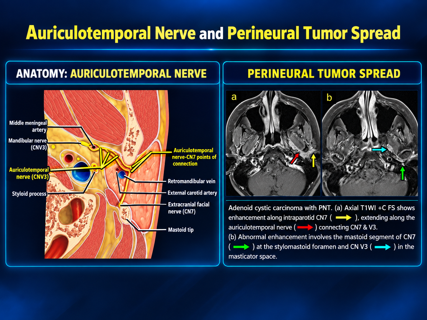 Anatomic diagram and two axial contrast-enhanced fat-suppressed T1 MRI images with colored arrows labeling facial, auriculotemporal, and V3 involvement.