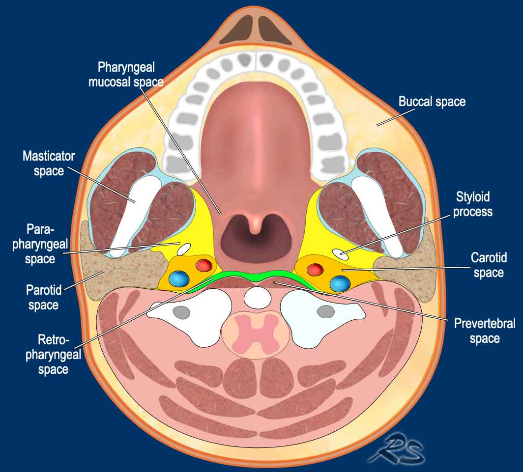 Axial teaching diagram labeling the retropharyngeal, pharyngeal mucosal, parapharyngeal, carotid, prevertebral, masticator, parotid and buccal spaces.