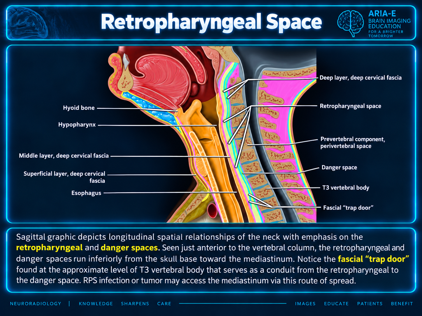 Sagittal teaching graphic labeling the retropharyngeal and danger spaces, fascial layers, hyoid, esophagus and T3 fascial trap door.