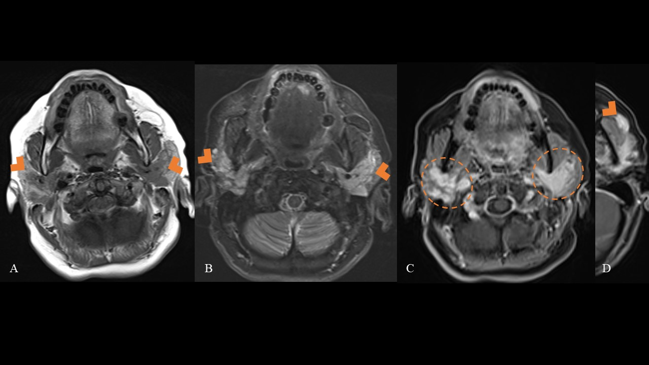Bilateral parotid gland enlargement. 



MRI imaging shows the affected areas as hypointense on T1-w images 



(A), and hyperintense on STIR sequences 



B). Post-contrast T1-w images with fat-sat 



(C) reveal diffuse, patchy, and intense enhancement of the parotid glands. 



Additionally, the left accessory parotid tissue is enlarged and shows the same intensity on MRI as the main parotid glands (D).
