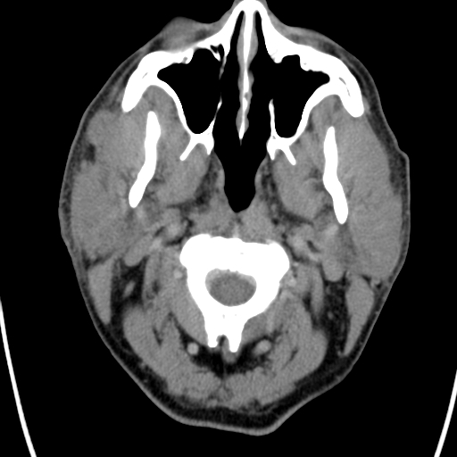 Sarcoidosis



Diffuse homogeneous enlargement of both parotid gland is seen, particularly involving the superficial lobes.  



The adjacent masseter muscles also appear infiltrated.

Lobulated enlargement of right accessory parotid tissue in the right cheek is evident.



There is stranding in the adjacent fat around both parotid glands.