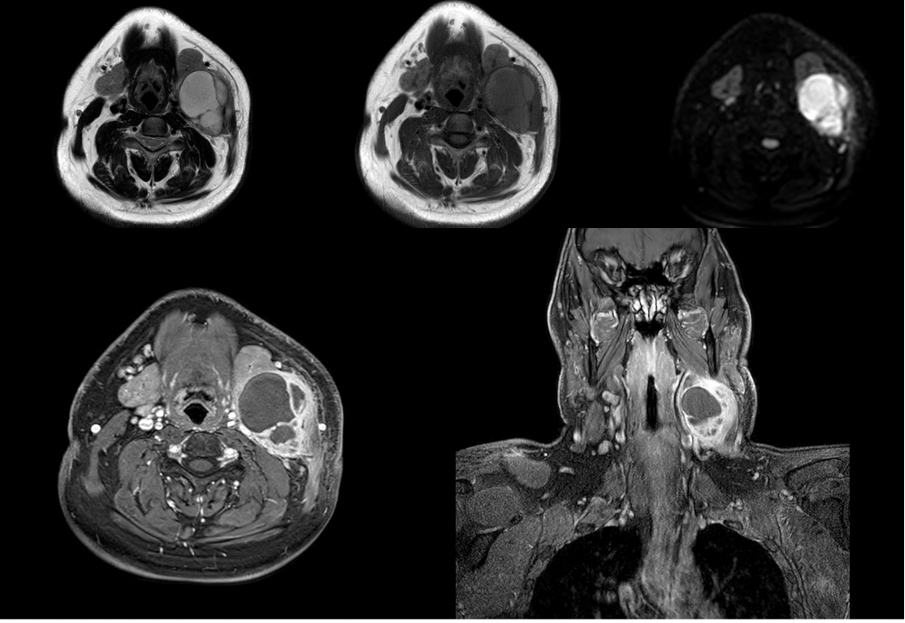 Second branchial cleft cyst (Infected)