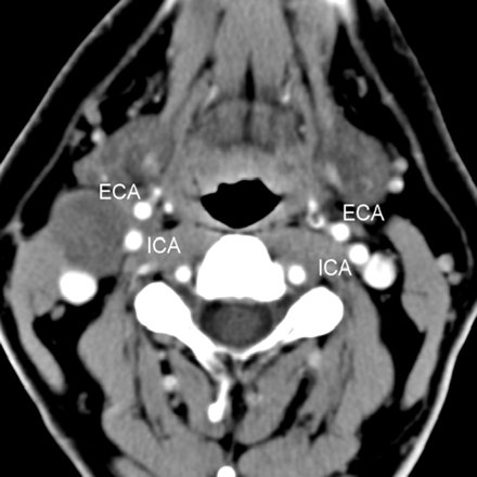 Second branchial cleft cyst