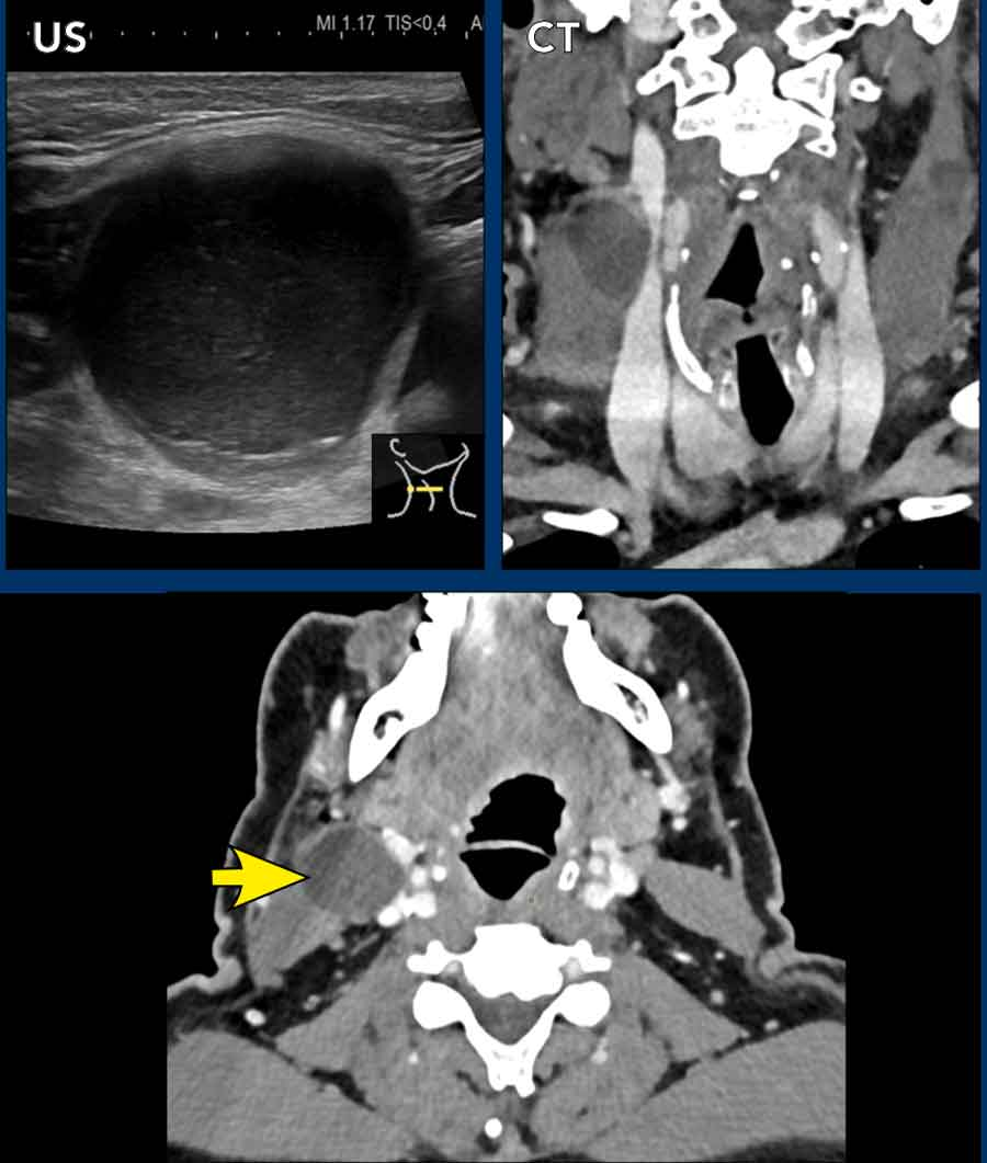 Second branchial cleft cyst