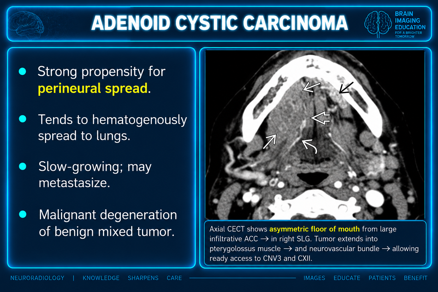 Axial contrast CT with arrows at an infiltrative right sublingual-gland lesion and adjacent extension