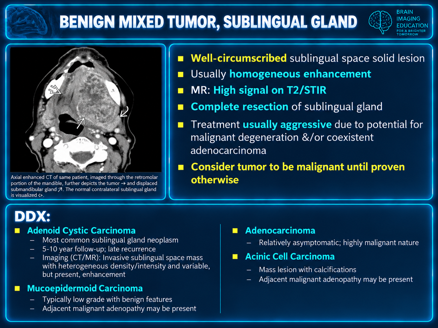 Axial contrast CT teaching slide with arrows identifying a large floor-of-mouth tumor and displaced gland