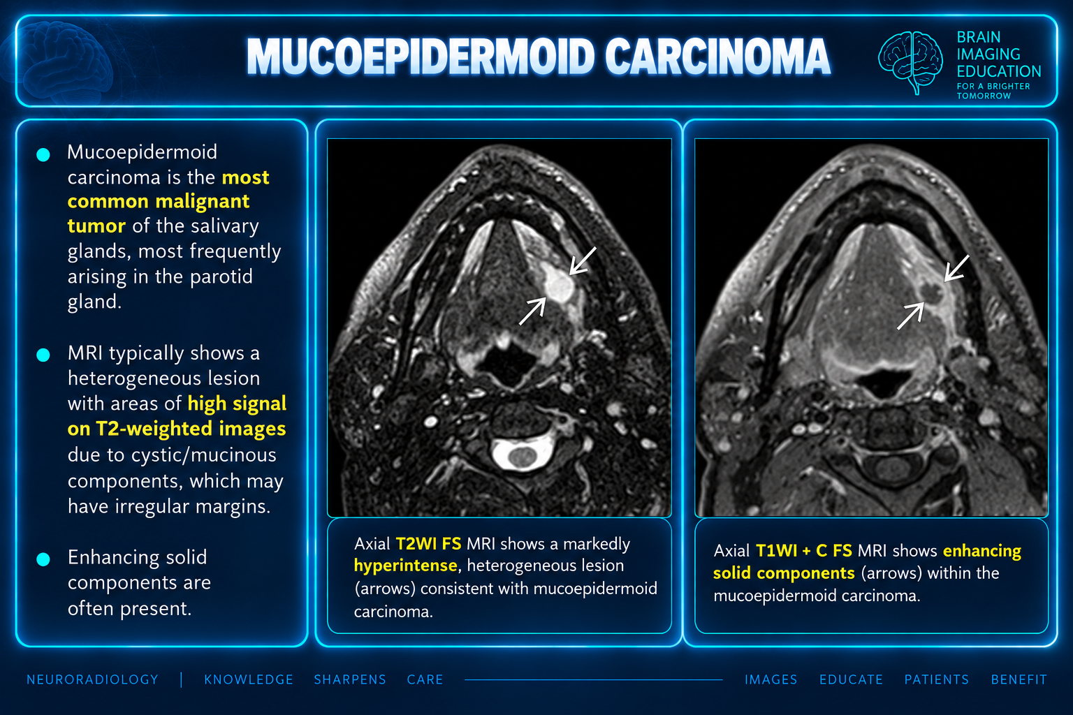 Paired axial fat-suppressed T2 and postcontrast T1 MR images with arrows at a heterogeneous sublingual lesion