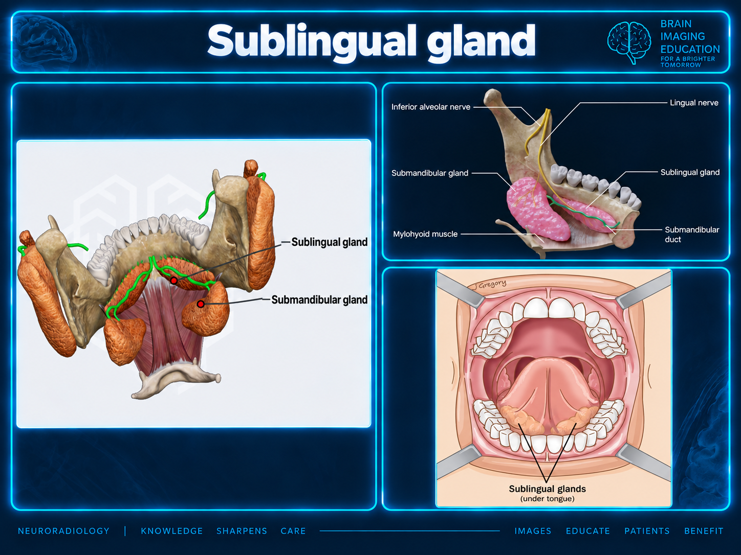 Teaching illustration showing sublingual and submandibular glands, their ducts, the lingual nerve, and the floor of mouth.