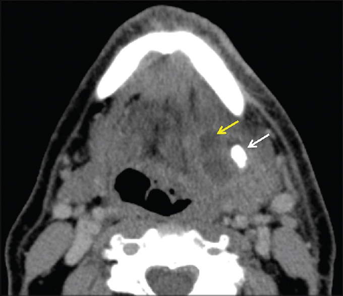Axial CT with preserved yellow and white arrows indicating a low-attenuation region and a dense stone; supplied caption: Abscess with stone.