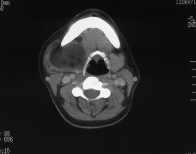 Axial CT showing a low-attenuation submandibular-region lesion; supplied caption: Dermoid.