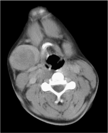 Axial CT showing a rounded submandibular-region mass; supplied caption: Pleomorphic adenoma.