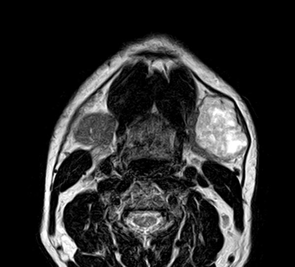 Axial MRI showing a heterogeneous bright submandibular-region mass; supplied caption: Pleomorphic adenoma.