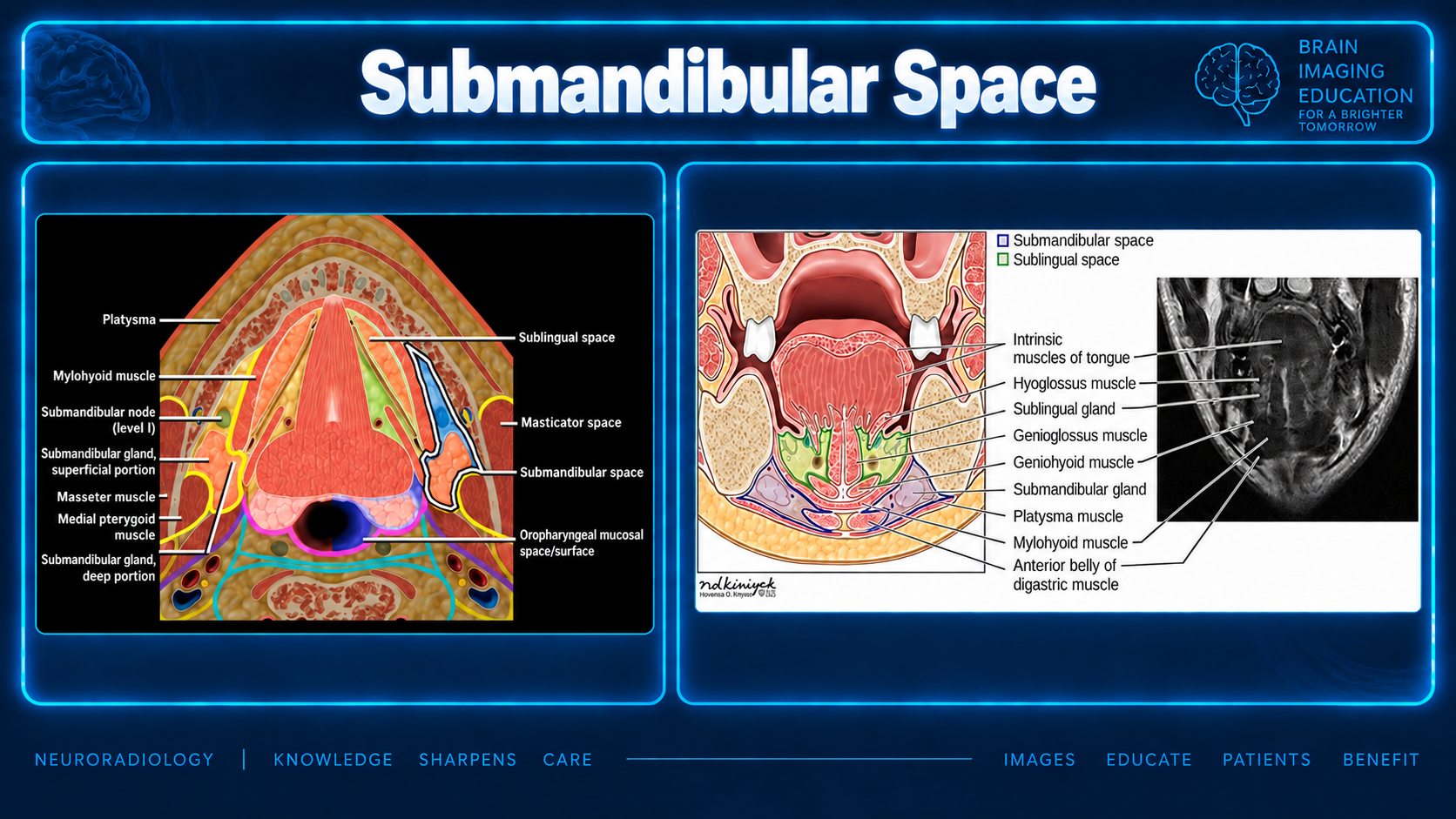 Teaching slide with labeled axial and coronal submandibular anatomy and coronal MRI.