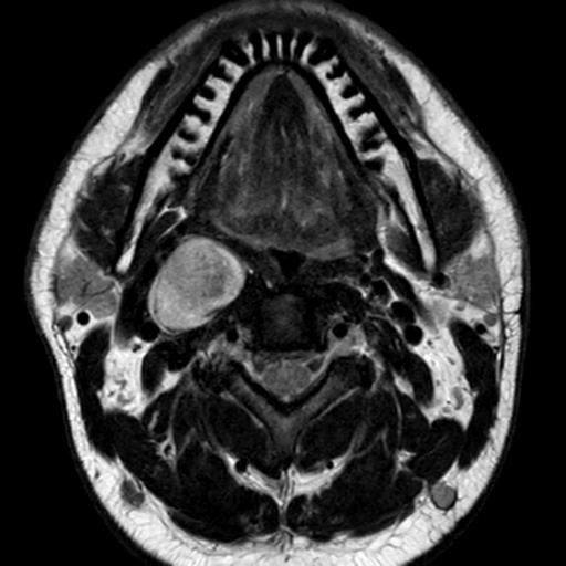 Sympathetic chain schwannoma



Lesion is right post-styloid parapharyngeal space, medial to the carotid space. 



The lesion measures 4 x 2.4 x 2.6 cm (CC x AP x ML), over C1-C3 levels. 



No evidence of flow voids within the lesion. 



The lesion is longitudinally oriented without neural foraminal extension. 



There is no arterial phase enhancement. In the delayed phase, the lesion shows homogeneous enhancement.



The lesion displaces the internal carotid artery and internal jugular vein laterally (in the same direction) without separating nor encasing the vessels.
