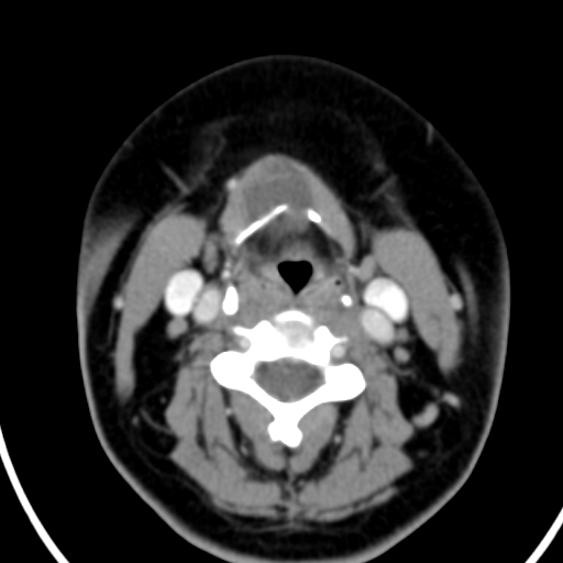 Thyroglossal cyst protruding into the pre-epiglottic space