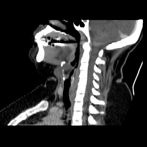 Thyroglossal cyst protruding into the pre-epiglottic space