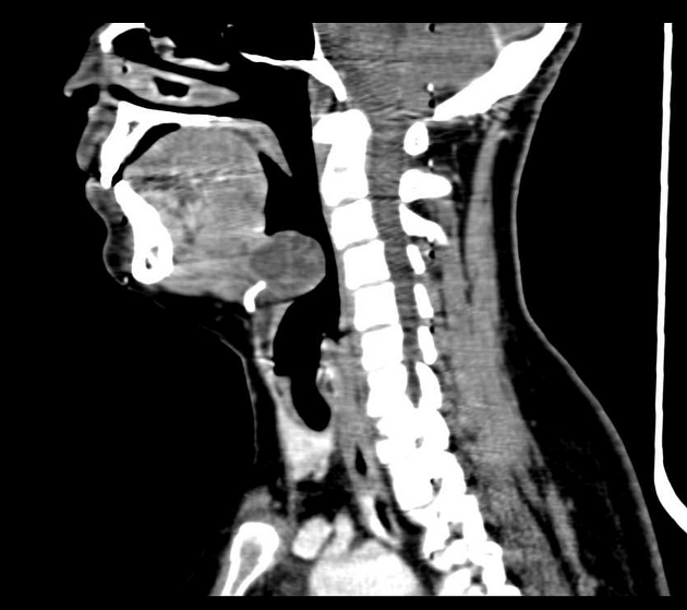 Lingual thyroglossal duct cyst