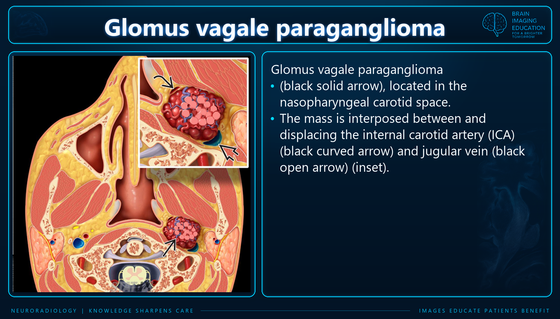 Glomus Vagale Paraganglioma