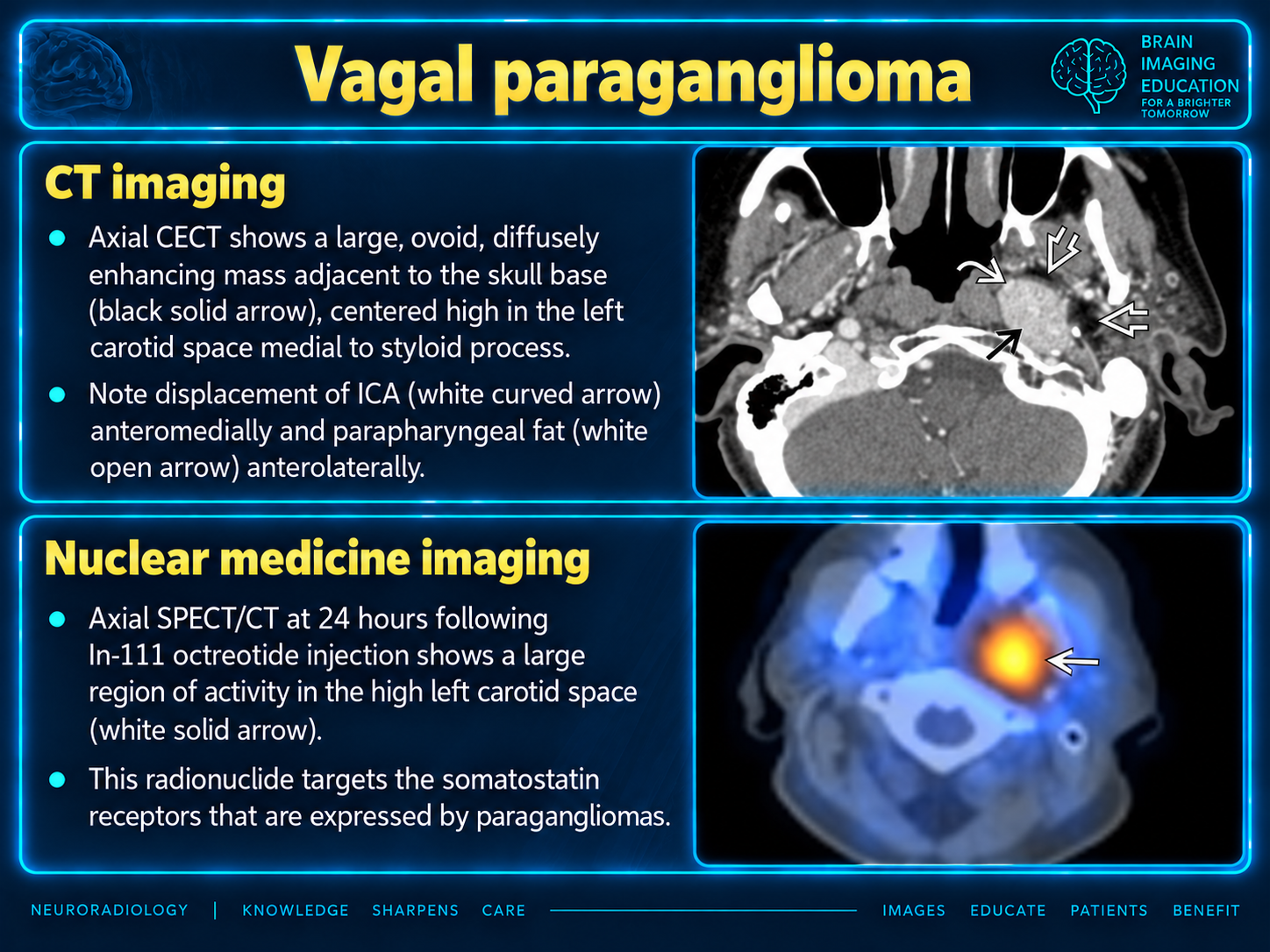 Glomus Vagale Paraganglioma