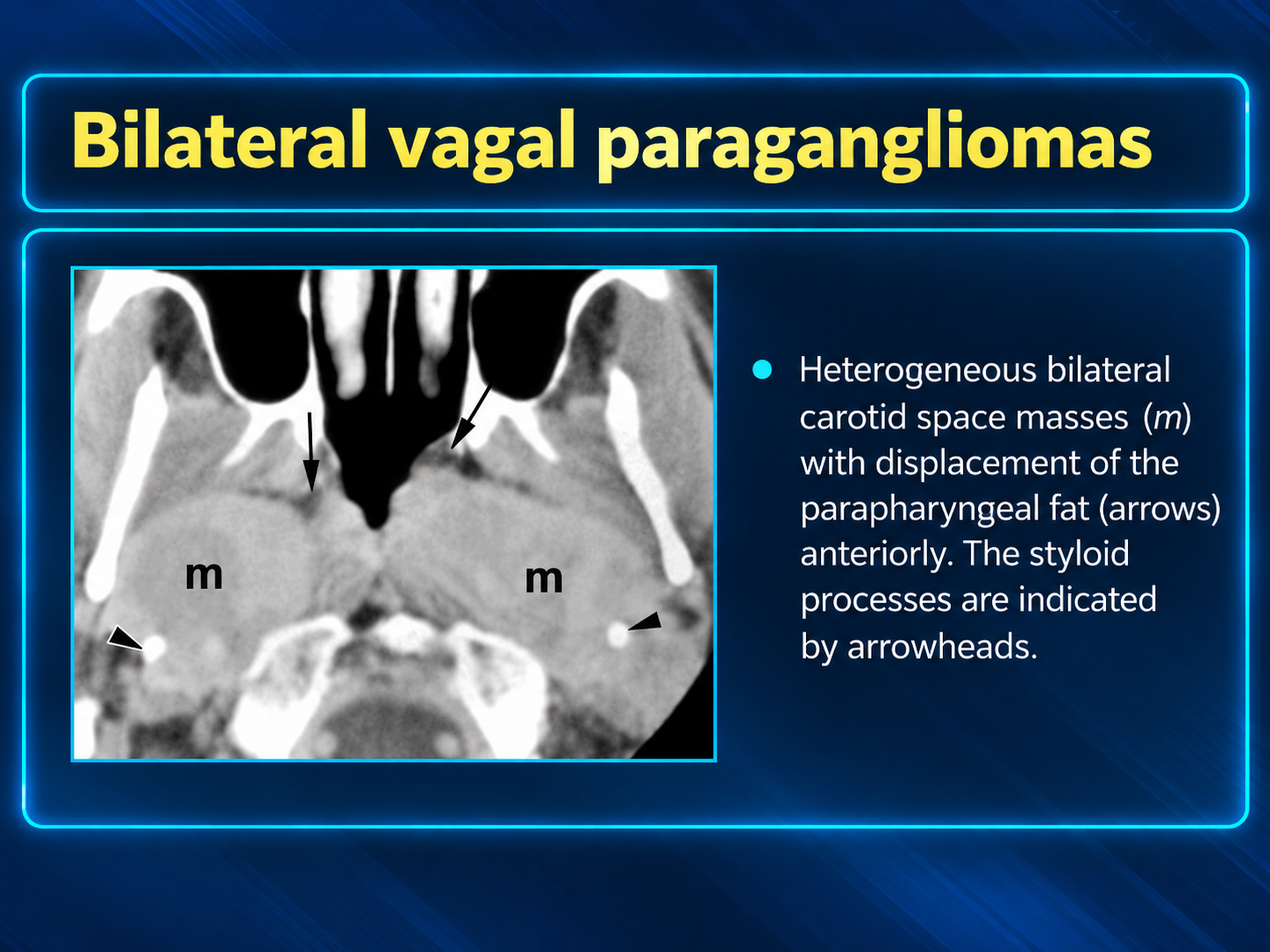 Glomus Vagale Paraganglioma