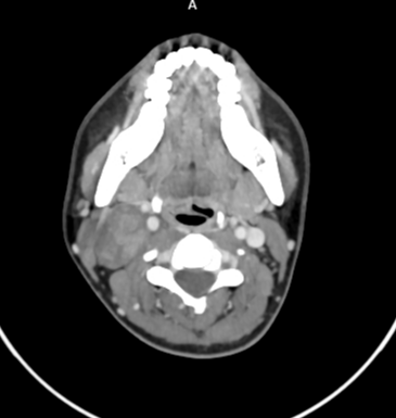 Vagal schwannomas



Lesion in the right upper cervical region below the sternocleidomastoid muscle. 



The lesion displaces the right internal & external carotid arteries medially and the internal jugular vein laterally. 



Mild patchy areas of heterogeneous enhancement were seen within the lesion on post-contrast images.



Displacement of the internal carotid artery anteromedially and internal jugular vein laterally by the lesion is characteristic of vagal schwannoma