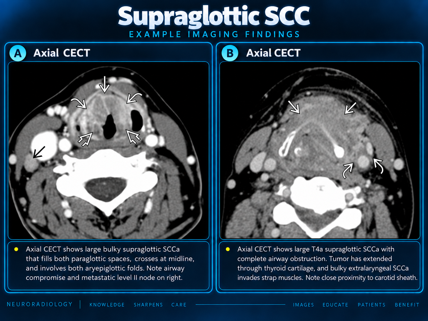Advanced supraglottic SCC comparison
