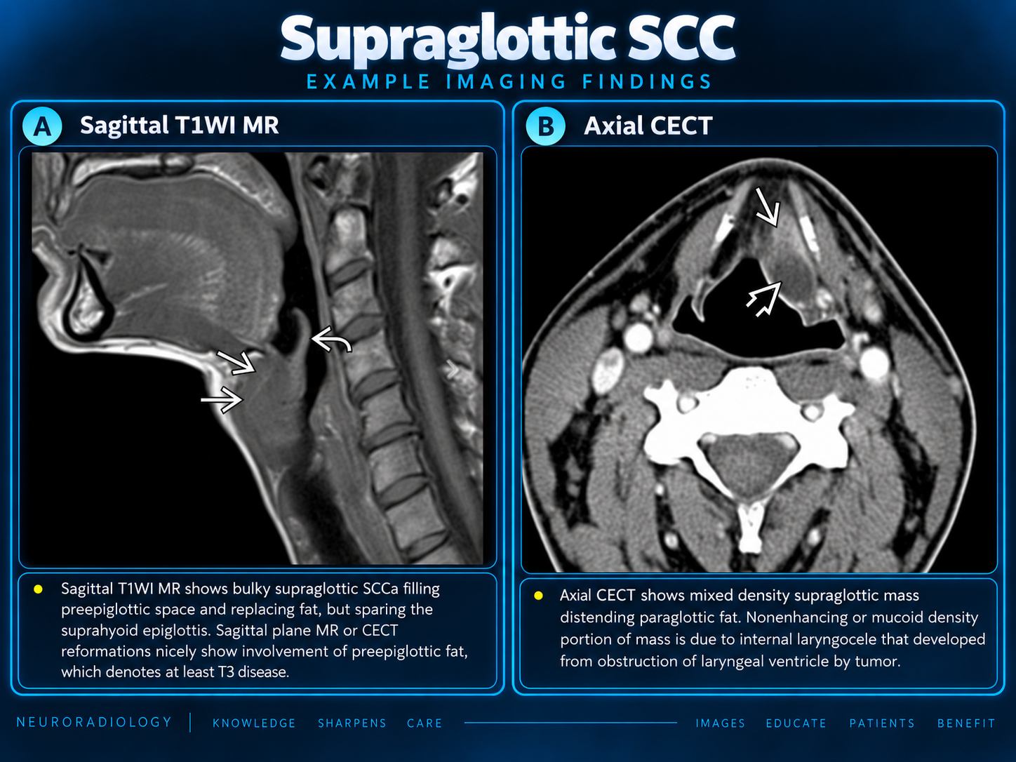 Supraglottic SCC deep-space comparison