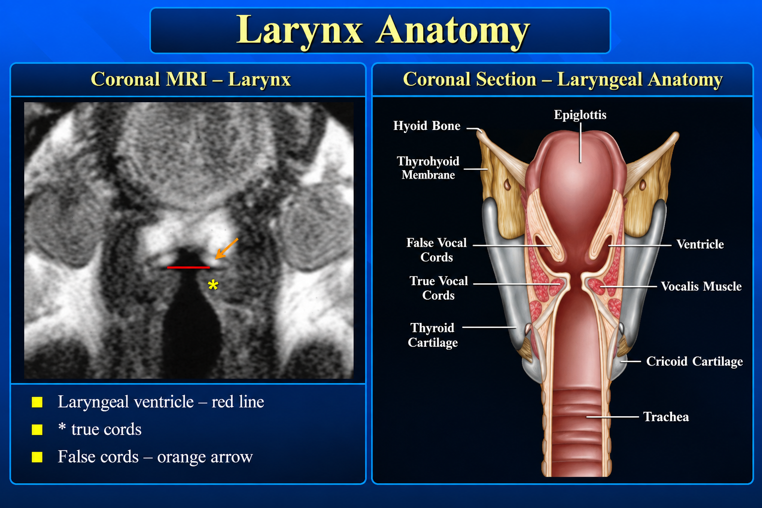 Coronal MRI and illustration of laryngeal anatomy